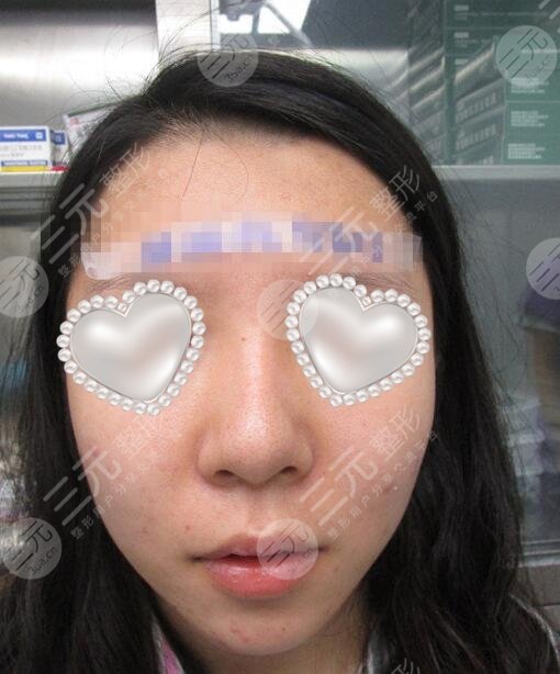 重庆西南医院整形科垫鼻子做的怎么样？蜕变案例图分享~