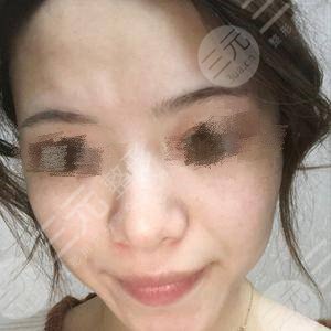 中国医学科学院皮肤病医院激光祛斑案例