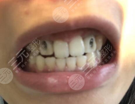 威海王云惠牙齿种植案例
