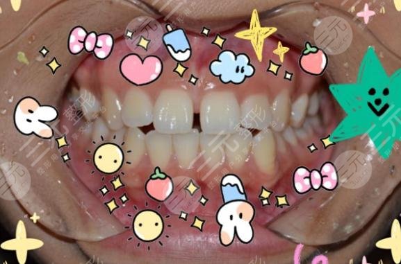上海九院口腔科牙齿矫正案例