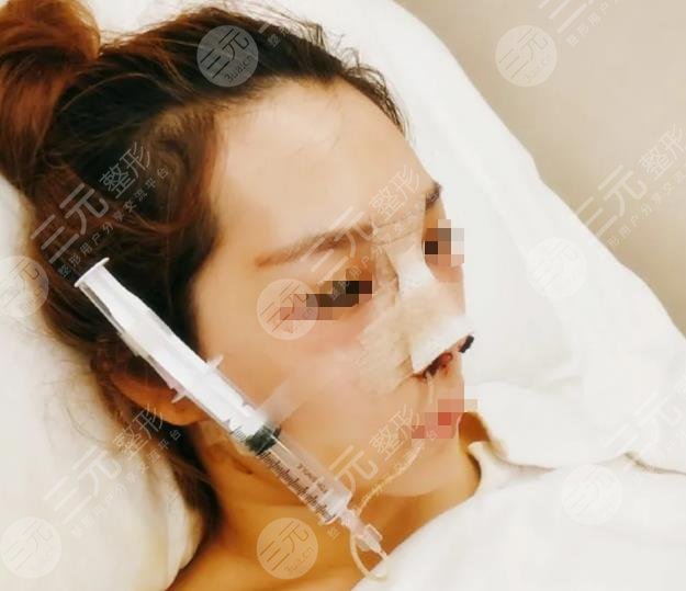 西安西京医院鼻部手术案例