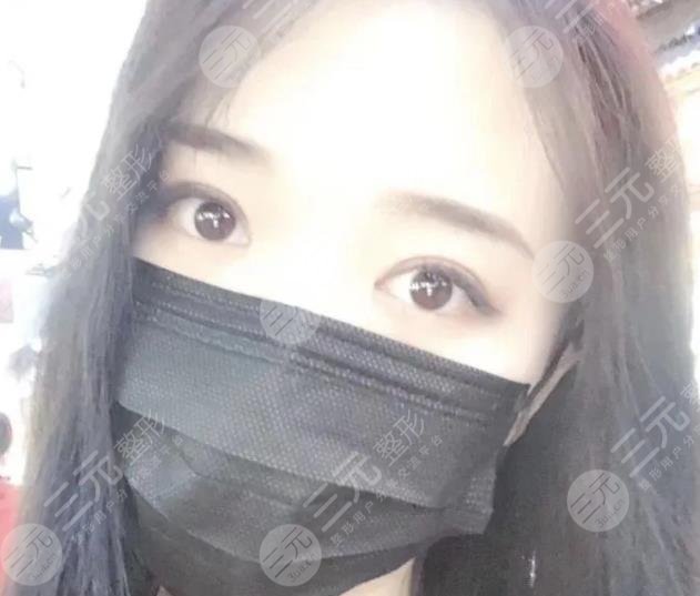 北京八大处李海东医生双眼皮案例