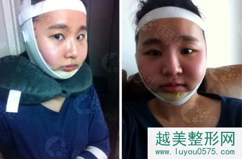 在韩国安菲拉整形医院做面部轮廓第7天