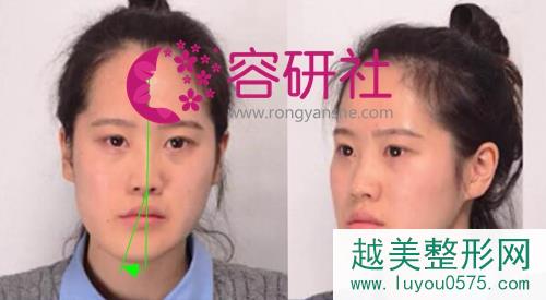 韩国爱宝整形医院颜面不对称+反颌矫正术前