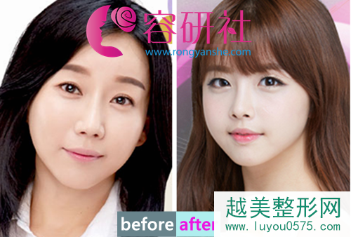 韩国原辰整形外科全脸提升术打造饱满童颜脸