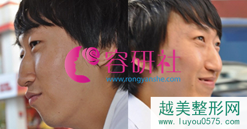 韩国POP整形外科鼻部手术手术前