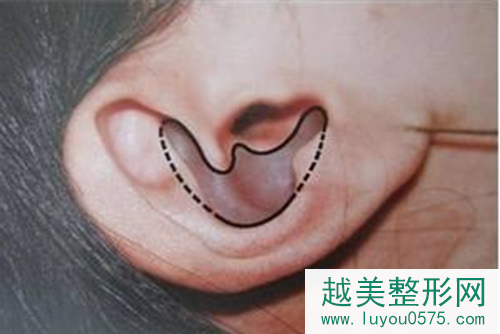 耳软骨隆鼻对身体有什么影响
