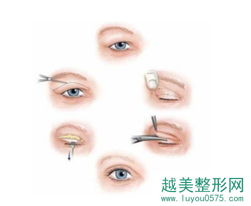 双眼皮手术失败后变成多眼皮修复过程示意图
