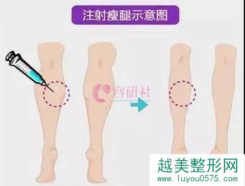 注射瘦脸瘦小腿的手术方式