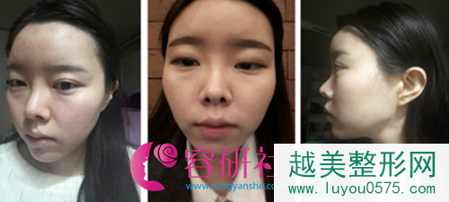 韩国灰姑娘整形医院鼻修复+轮廓手术前