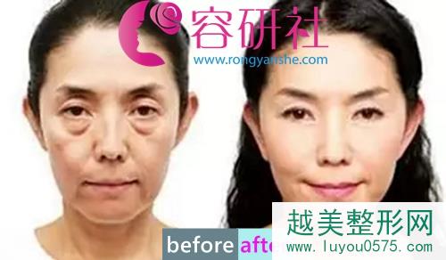 60岁李阿姨去眼袋前后对比，告别衰老，挽回青春