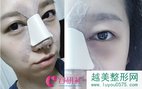 韩国丽珍整形医院鼻部手术手术术后3天