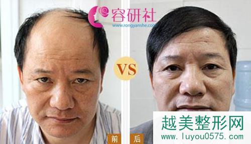 植发手术前后果对比