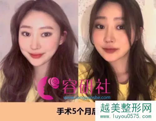 韩国id整形医院面部轮廓+鼻部手术手术后5个月