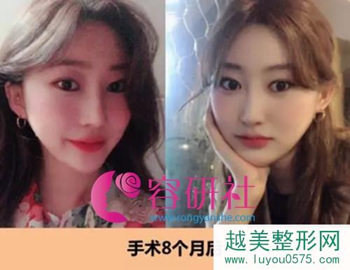 韩国id整形医院面部轮廓+鼻部手术手术后8个月