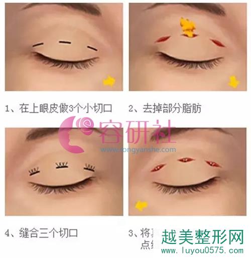 韩式三点双眼皮手术方式