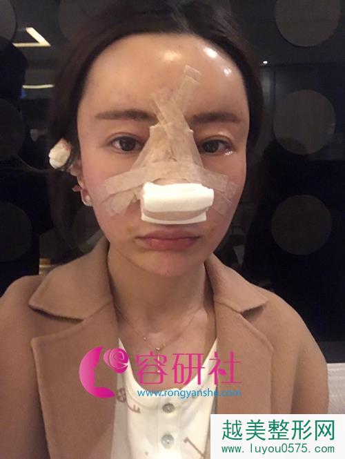 韩国碧夏整形医院额头自体脂肪填充+肋软骨隆鼻手术后第1天