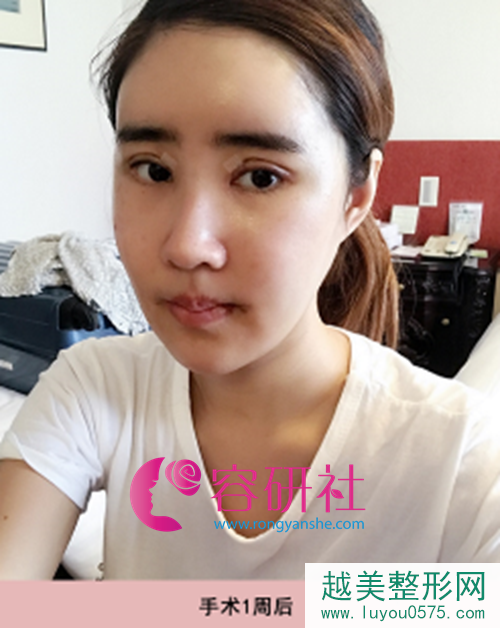 韩国ID整形医院轮廓+鼻部手术手术后第7天