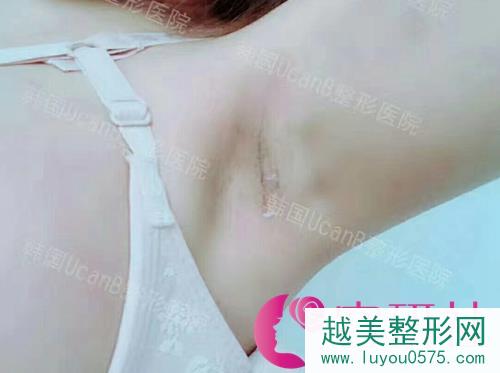 韩国UcanB整形医院金骏昊院长假体隆胸术后1个月腋下疤痕状态