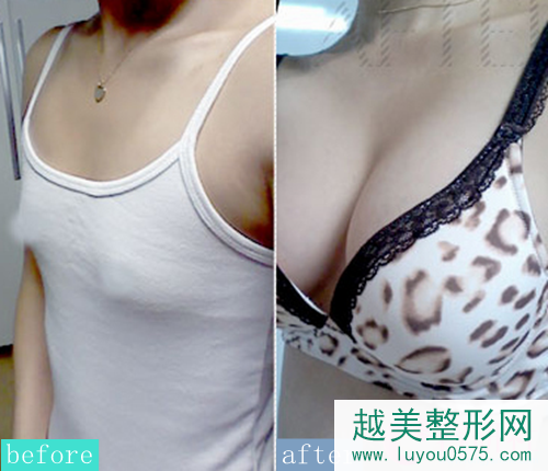 韩国原辰整形外科自体脂肪隆胸前后对比图
