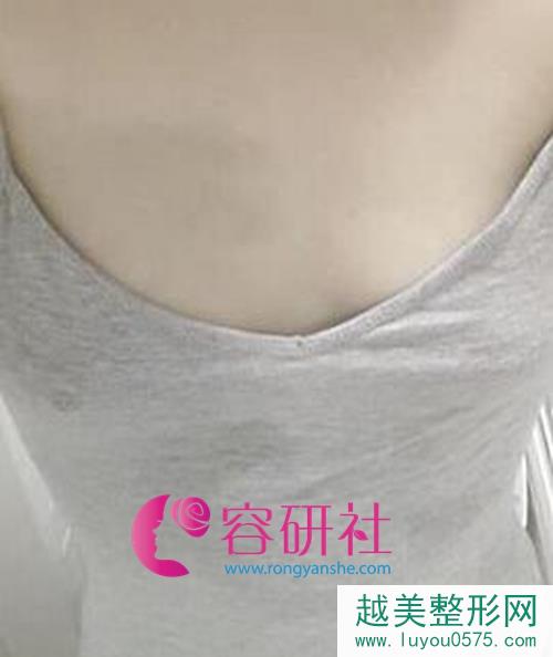韩国原辰整形假体隆胸手术前