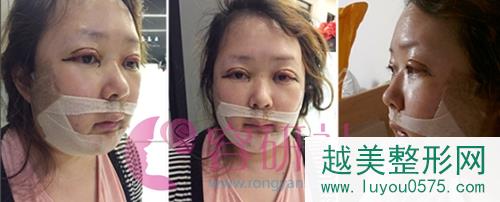 韩国灰姑娘整形医院轮廓手术术后第一天
