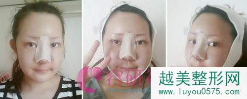 韩国灰姑娘整形医院鼻部手术整形术后第1天