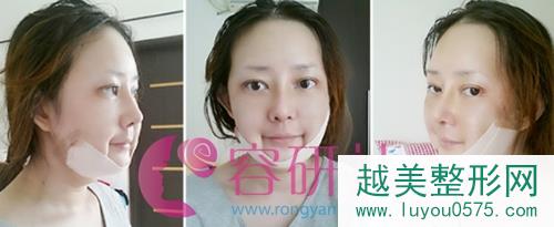 韩国灰姑娘整形医院鼻部手术整形术后第7天