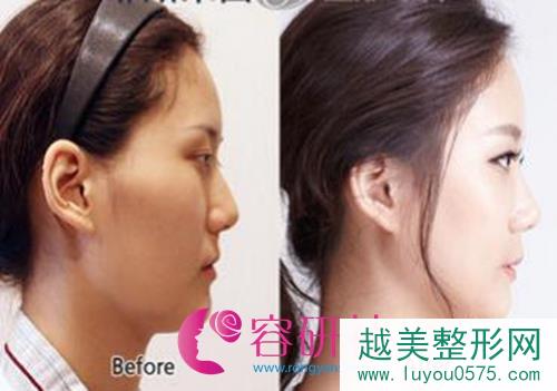 韩国face-line整形医院李真秀院长面部轮廓手术案例