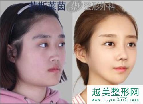 韩国face-line智能双颚面部轮廓案例对比图