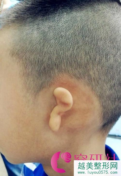 先天性小耳畸形怎么办？