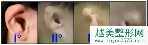 耳廓畸形根据严重程度分为四级