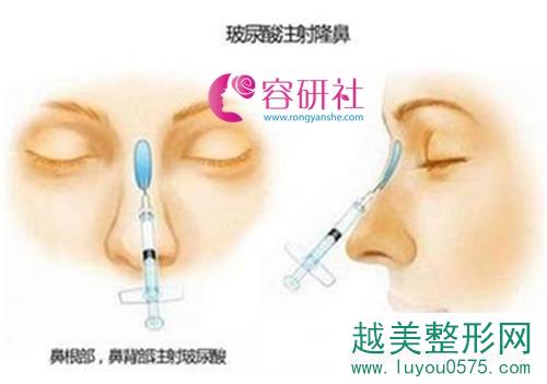 玻尿酸隆鼻注射方式