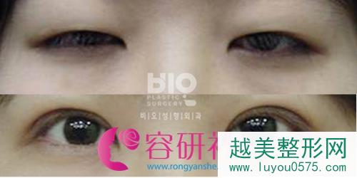 韩国bio整形医院双眼皮修手术案例