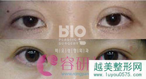 韩国bio整形医院双眼皮修复案例