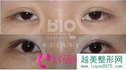 韩国bio整形医院双眼皮手术案例