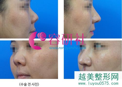 韩国高诺鼻coconopi整形医院鼻部手术手术案例