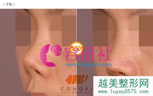 韩国高诺鼻coconopi整形医院鼻修复手术案例