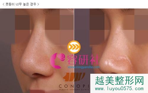 韩国高诺鼻coconopi整形医院鼻修复手术案例