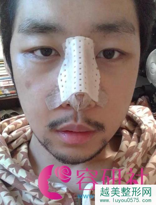 韩国原辰鼻部手术手术案例照片