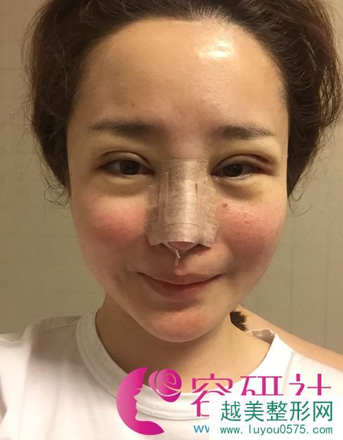清潭first鼻部手术手术案例照片