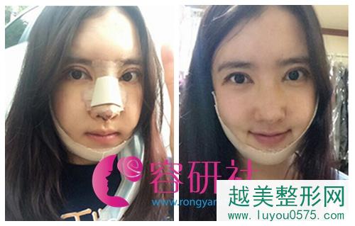 韩国灰姑娘整形医院的面部综合整形术后一周后