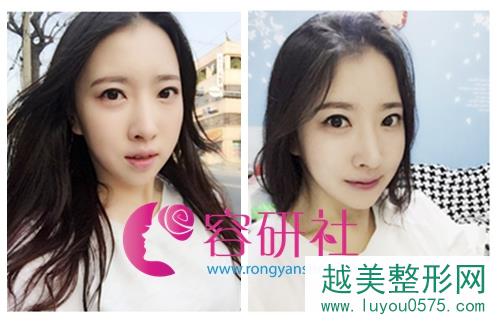 韩国灰姑娘整形医院的面部综合整形术后6个月后