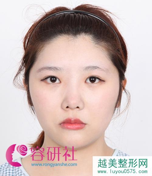 韩国faceline医院的颧骨缩小术+眼鼻部手术术前