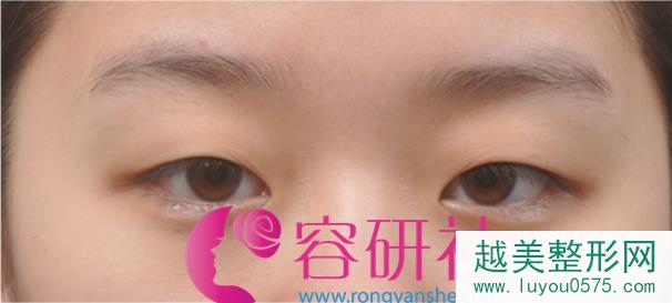  韩国新帝瑞娜（灰姑娘）医院眼提肌+双眼皮+前眼角术前