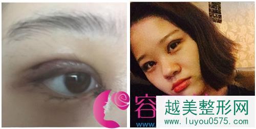  韩国新帝瑞娜（灰姑娘）医院眼提肌+双眼皮+前眼角手术前期