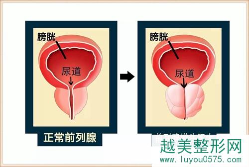 韩国世檀塔男科医院李昌敏讲解正常前列腺与前列腺增生肥大的区别