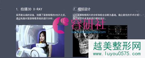 韩国菲斯莱茵整形外科无切除提升颧骨缩小术 诊断过程