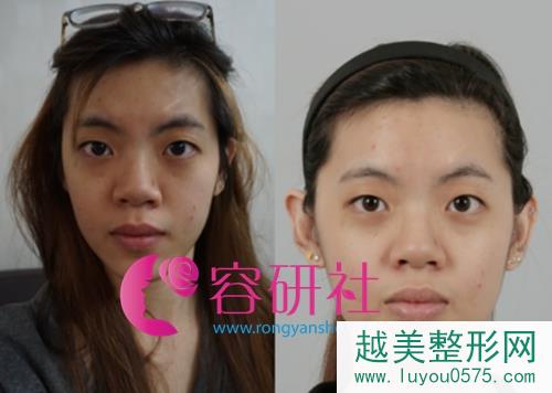 韩国ID整形医院金一焕院长双眼皮手术+眼型矫正术前