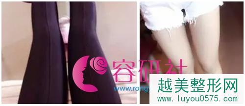 韩国dreamline吸脂塑形医院大腿吸脂术后1个半月